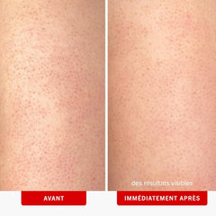First Aid Beauty KP Bump Eraser Body Scrub with 10% AHA, Keratosis Pilaris Skin Exfoliator with Glycolic and Lactic acids